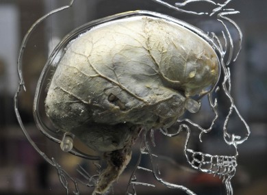 File photo of a real human brain suspended in liquid with a to-scale skeleton